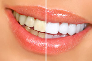 Cosmetic Dentistry - Santa Maria