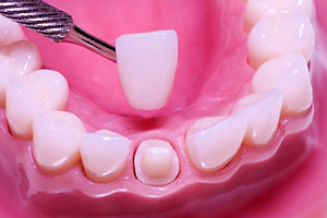 Dental Restoration - Santa Maria