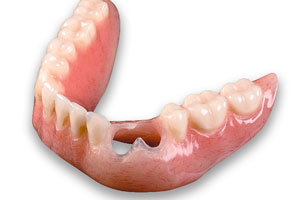 Dental Restoration - Santa Maria